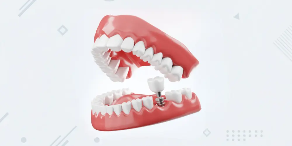 Implantes